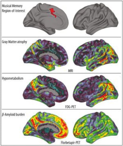 O gráfico mostra (em vermelho, acima) o giro cingulado anterior, onde as memórias musicais são armazenadas. Mais abaixo, visão bilateral de três biomarcadores da doença de Alzheimer; em vermelho, as áreas mais afetadas.