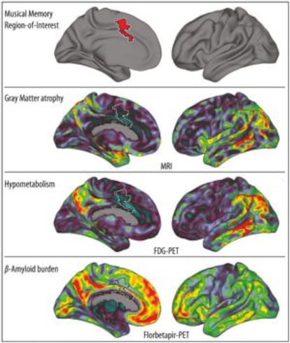 El gràfic mostra (en vermell, a dalt) la circumvolució del cíngol anterior, on s'emmagatzemen els records musicals. Més avall, visió bilateral de tres biomarcadors d'alzheimer, en vermell les més afectades.