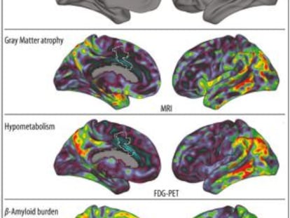 O gráfico mostra (em vermelho, acima) o giro cingulado anterior, onde as memórias musicais são armazenadas. Mais abaixo, visão bilateral de três biomarcadores da doença de Alzheimer; em vermelho, as áreas mais afetadas.