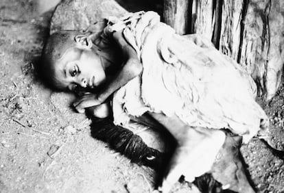 Un niño con evidentes signos de desnutrición, durante la hambruna de Etiopía en 1973.