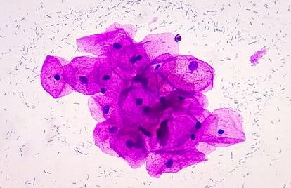 Gonorrea