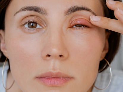 Con estos productos es posible reducir el picor e hinchazón causados por la dermatitis en párpados. GETTY IMAGES.