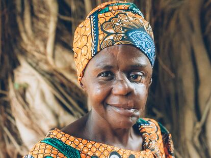 Mulikat Okanlawon, de 38 años superviviente de noma en Nigeria, el pasado mes de mayo.