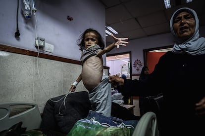 Una niña con desnutrición en el hospital de Deir al Balah (Gaza), el 31 de mayo.