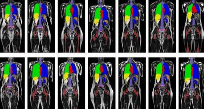 Escáneres de pacientes sobre los que el sistema de visión artificial identifica los órganos que pueden verse afectados por la radioterapia.