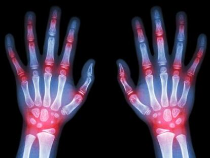Cambio de escenario en la artritis reumatoide