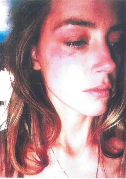 Imagen de Amber Heard tras una supuesta agresión de Johnny Depp.