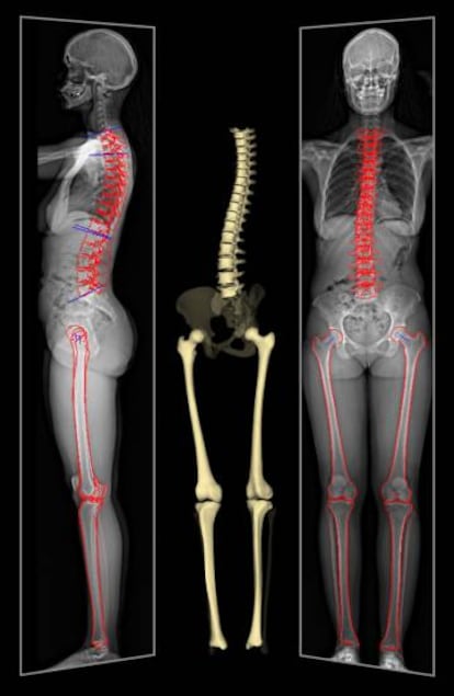 La radiografía completa en 2D permite realizar diagnósticos certeros sobre problemas de columna. (Foto: Instituto Clavel). 