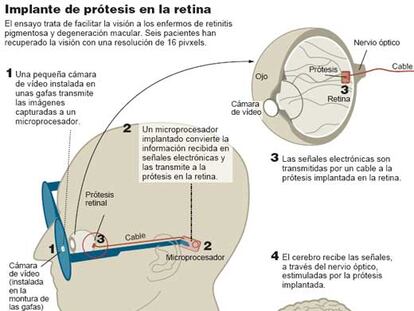 Implante de prótesis en la retina