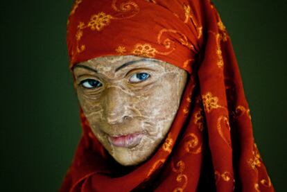 Abrasada por su marido. Nila tiene 17 años. Con 13 fue quemada con ácido por su esposo, a 170 kilómetros de Dhaka.