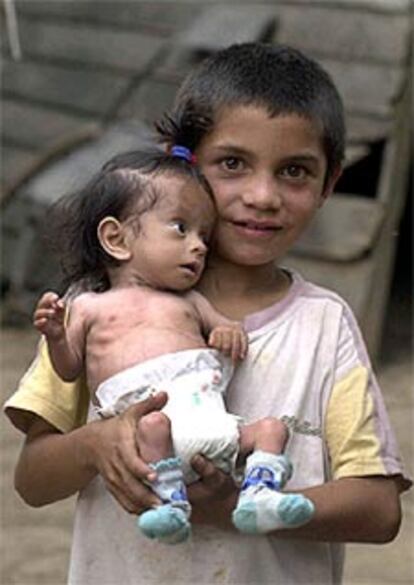 Un niño sujeta a su hermana de seis meses con síntomas de desnutrición.