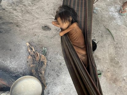 Niña Yanomami con desnutrición y malaria, en la aldea de Maimasi, Brasil