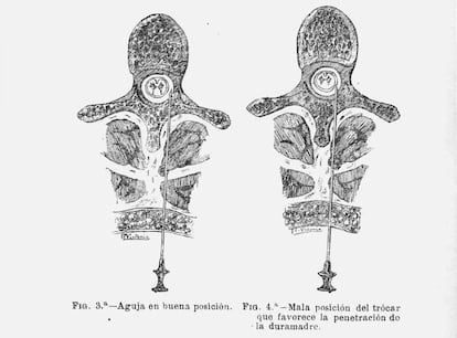 Imagen del dibujo del artículo 'Anestesia metamérica' donde Fidel Pagés describe cómo poner la aguja.