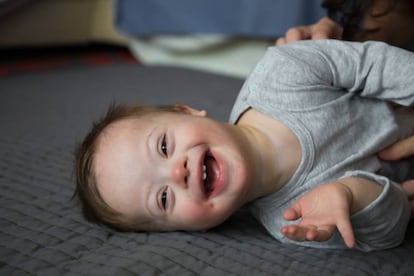 Niño con síndrome de Down. 