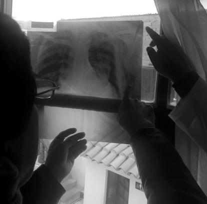 <p>Septiembre de 2014</p><p>Una radiografía es un mapa complejo que nos da pistas para entender la geopolítica del cuerpo, un pedazo de plástico con formas blancas, como volutas de humo, que esconde mensajes cifrados: a veces nos indica el camino hacia la salvación o hacia el purgatorio; y cuando el estado del paciente es grave, suele convertirse en una sentencia de muerte.</p><p>Una de las primeras que le hicieron a John Mamani anunciaba marejada. En la fotografía que él sacó mientras se la explicaban, hay varias manos que fijan la placa en una ventana cerrada para distinguir —y traducir— los claroscuros. “El de los lentes, el de la izquierda —explica Mamani—, era el neumólogo. Y el de la derecha, el cirujano”.</p><p>Ambos le hicieron notar que uno de sus pulmones no inflaba correctamente: de ahí, sus síntomas de asfixia. En la radiografía el pulmón afectado es una mancha blanca: una especie de caverna invadida por una neblina. “Yo era consciente de que algo pasaba porque mi cuerpo no reaccionaba —dice Mamani—. Y comencé a desconfiar de todo”. Y también, a cansarse del mismo decorado día tras día.</p>