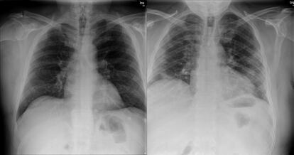 A la izquierda, radiografía que indica negativo en covid-19. A la derecha, radiografía que indica positivo. (CEDIDA POR FRANCISCO HERRERA)