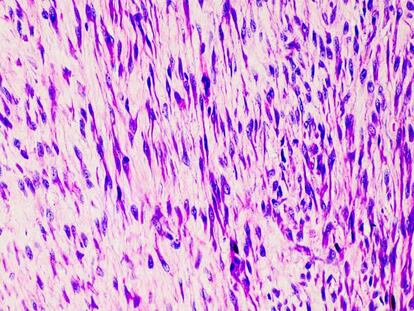 Minoryx Therapeutics: luchando contra las enfermedades raras