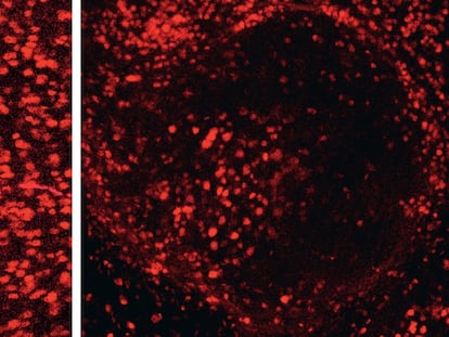 Mouse neurons (left) and degenerated human neurons in the mouse brain displaying Alzheimer's symptoms.