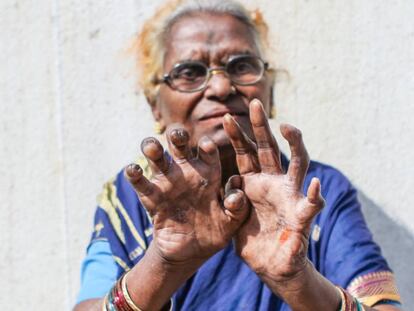 Jaibai Gaikowad, de 70 años, contrajo lepra hace 15, cuando aun se tardaba en detectar y tratar.