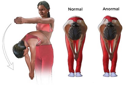 Test de Adams para diagnosticar la escoliosis idiop&aacute;tica.