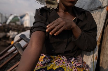 Una mujer en el campo de desplazados de Bulengo, en Goma (República Democrática del Congo), mostraba posibles síntomas de viruela del mono el 15 de agosto.