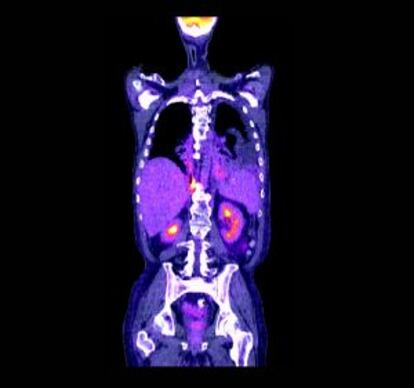 Tomografía de un cáncer de pulmón.