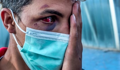Uno de los jóvenes marroquíes heridos durante la paliza que le propinaron un grupo de hombres canarios, tras cerciorarse de que era marroquí, según su testimonio, en el barrio Las Rehoyas.