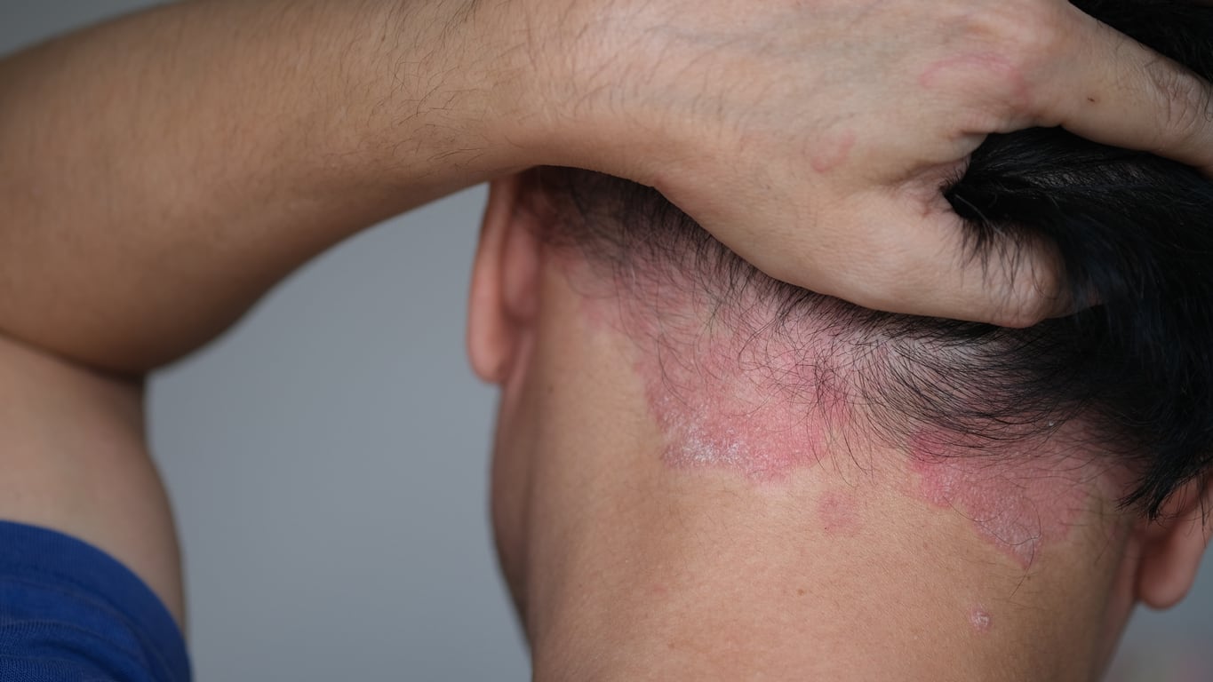 Placas de psoriasis en el cuero cabelludo, una de las localizaciones especiales de esta enfermedad inflamatoria inmunomediada.