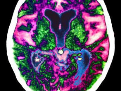 Imagen de un cerebro con alzh&eacute;imer.