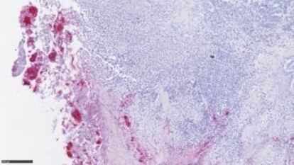 Un tumor colorrectal infiltrado por 'Fusobacterium' (en rojo).