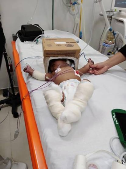 Un bebé de dos meses recibe oxígeno con un casco de cartón en el hospital de Tekax, Yucatán.