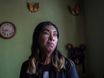 Esmeralda Millan, sobreviviente de un ataque con ácido de su expareja, posa en 2021.