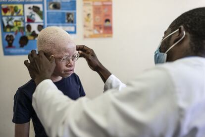 Los albinos presentan una tendencia natural a tener una sensibilidad ocular debido a la falta de pigmentación. La mayoría de las personas con albinismo carece de condiciones económicas para acceder a la atención oftalmológica, por lo cual a ellos se le ofrecen gafas gratuitas; es una atención especial para que puedan mejorar su capacidad visual.