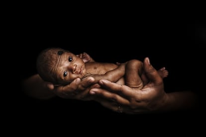 Muskan. Bangladés. <p>El nivel de riqueza determina el tiempo en que la madre amamanta a su hijo en los países de ingresos medios y bajos. Las tasas de lactancia materna a los dos años son 1,5 veces más elevadas entre los bebés de las familias más pobres que en los de las familias más ricas. Las brechas son más acusadas en África Occidental y Central y en América Latina y el Caribe.</p> <p>En la imagen, Muskan, de 47 días, entre los brazos de su madre Sumona Akhtar Juthie, de 21 años, en las Unidades de cuidado especial para recién nacidos del Instituto de Salud Infantil y Materna en Dhaka, Bangladés, el 17 de febrero de 2018.</p> <p>La niña, cuyo nombre significa sonrisa en bengalí, nació prematura a los 6,5 meses de embarazo, el pasado 2 de enero. Pesaba apenas 700 gramos, pero ahora ha alcanzado los 1,2 kilos. En Bangladés, alrededor del 14% de los bebés nace prematuramente. <p>"Me resbalé y caí durante mi embarazo y luego comencé a tener trabajo de parto. Di a luz en casa; mi tía me ayudó y cortó el cordón. Mi padre llamó a una ambulancia tan pronto como vimos que el bebé tenía dificultades para respirar. Intentamos que la admitieran en otros dos hospitales al principio, pero la rechazaron. Nos dijeron que estaban llenos. En el centro donde finalmente nos atendieron le dieron oxígeno a través de una máscara y le asignaron una cama [una incubadora] donde pasó 10 días. Si no hubiéramos venido, Muskan habría muerto”, asegura su madre. “La enfermeras me enseñaron cómo amamantar y pesar Muskan. El aumento de peso me dice que está bien".</p> <p>En 2016, Bangladés registró una tasa de mortalidad neonatal de 20 por cada 1.000 nacidos vivos, según datos de Unicef. La mayoría de los recién nacidos muere por nacimiento prematuro (31%), asfixia perinatal (22%) y sepsis (19%).</p>