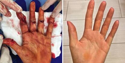 Estado de la mano de Kvitova, antes y después de la operación.