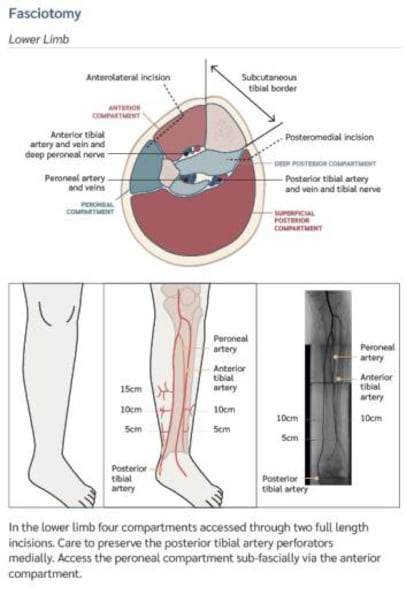 Página del manual pediátrico que ilustra y explicacómo realizar una fasciotomía a un niño.