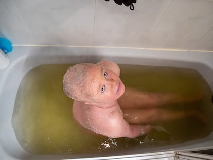 Ariadna López se toma un baño de alquitrán para hidratar su piel, descamada a causa de la ictiosis arlequín que padece.