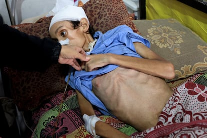 Un niño de 14 años con desnutrición en el Hospital de Al-Shifa, este martes.