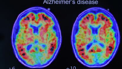 Evidence of Alzheimer’s disease in a study conducted with positron emission tomography.