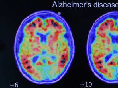 Evidence of Alzheimer’s disease in a study conducted with positron emission tomography.