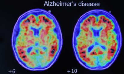 Alzheimer