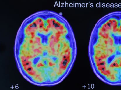 Evidencia de alzhéimer en un estudio realizado con tomografía por emisión de positrones.