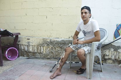 Eyad, de 22 años, necesita un injerto de hueso y una cirugía reconstructiva. 