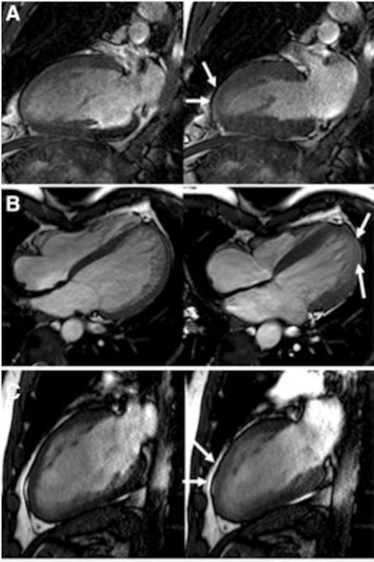 La cocaína lesiona el corazón antes de mostrar los primeros síntomas |  Ciencia | EL PAÍS