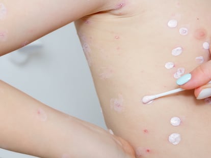 A person applies moisturizing cream to a child with measles.