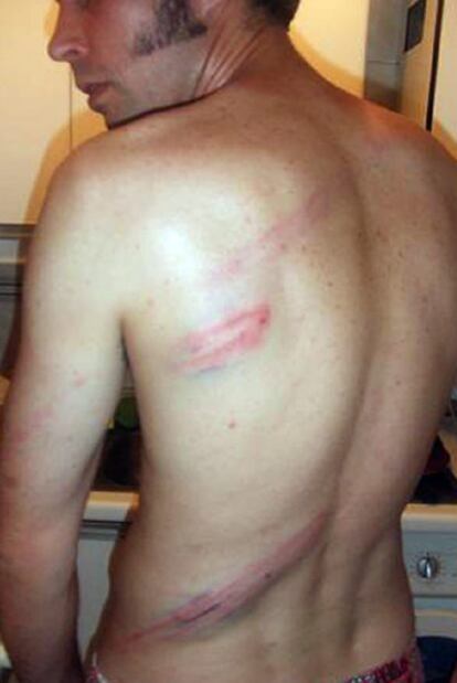 Lesiones producidas en la espalda y los muslos durante la agresión.