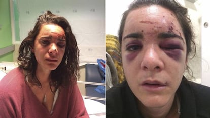 Andrea Sicignano in two photos of herself after the attack that she published on her Facebook account.