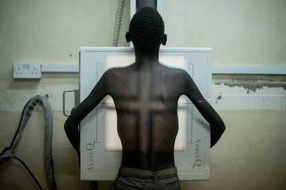 Simbazako, de 19 años y con tuberculosis, se hace una radiografía en Nsanje, Malaui. Aunque toma cada día sus antirretrovirales contra el VIH, su salud no mejora como él hubiese esperado.