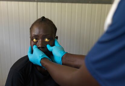 Nyemal tiene 22 años y vive en el campo de desplazados internos de Bentiu con su familia. Es positivo en hepatitis E, enfermedad para la que solo existe un tratamiento de apoyo de los síntomas y el estado de los pacientes para tratar de reducir su progresión.