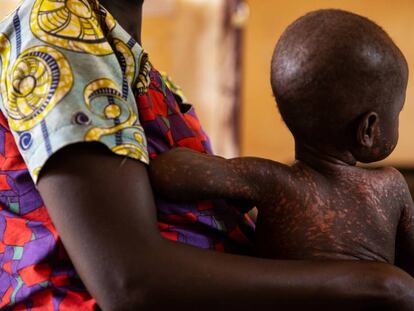 Desde principios de este año, República Centroafricana sufre una epidemia de sarampión, una enfermedad prevenible con vacuna.